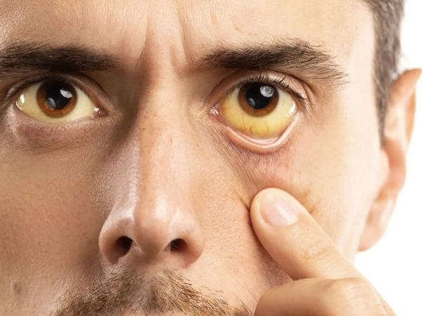 Vàng da và mắt là triệu chứng điển hình của nhiều bệnh về gan