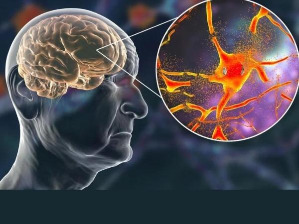 Bệnh lão hóa thần kinh