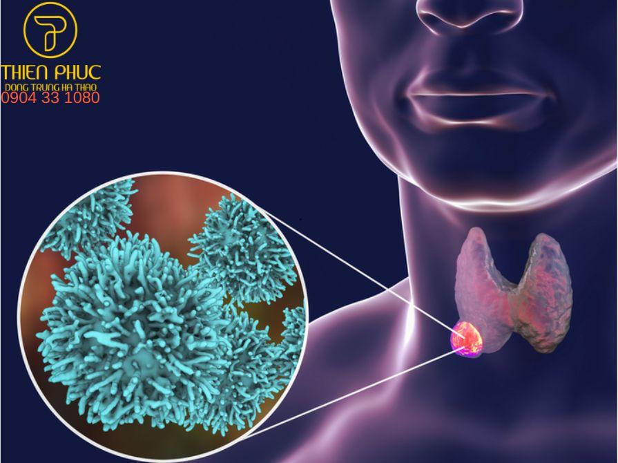 Người bệnh nên đi khám để tầm soát ung thư tuyến giáp