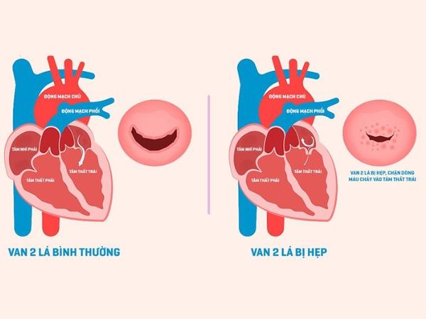 Hẹp van tim