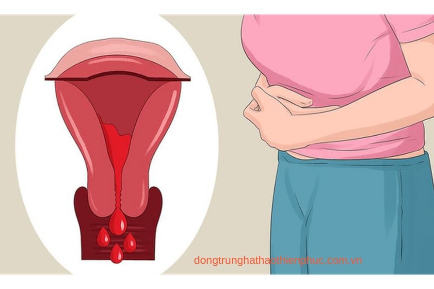 Triệu chứng và cách điều trị u nang buồng trứng dạng lạc nội mạc tử cung