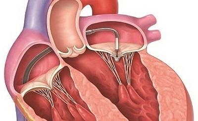 Những điều cần biết về bệnh van tim: nguyên nhân, triệu chứng, và cách điều trị