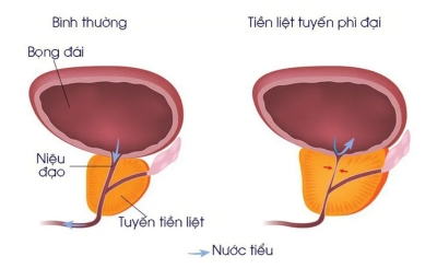 Nam giới bị bệnh tiền liệt tuyến có nên dùng đông trùng hạ thảo không – Tác dụng và cách sử dụng
